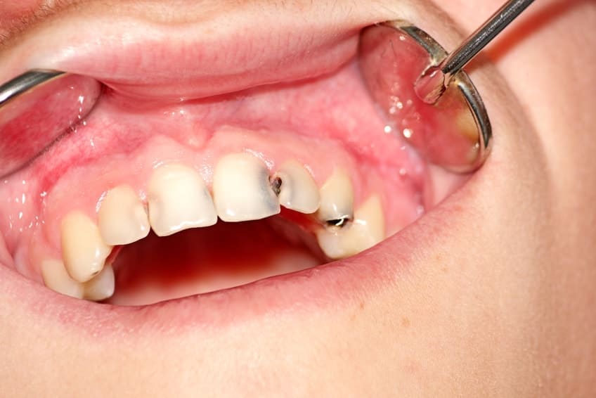 Powikłania leczenia ortodontycznego. Próchnica a aparat ortodontyczny
