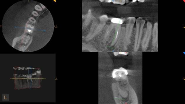 Tomografia zębów zastosowanie Brzesko Bochnia