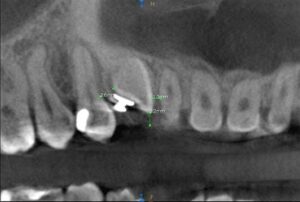Zdjęcie tomograficzne CBCT ortodoncja Brzesko Bochnia