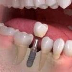 Proteza zębowa. Proteza stała. Proteza ruchoma Brzesko Bochnia