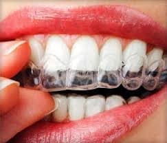 nakładki zębowe