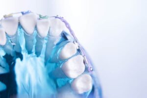 Aparat ortodontyczny. Rodzaje aparatów ortodontycznych. Lekarz ortodonta.