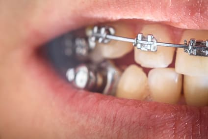 Implanty korekta aparatem ortodontycznym