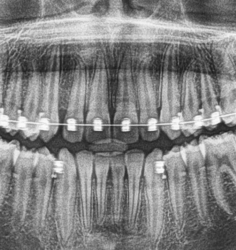 zdjęcie panoramiczne ortodoncja
