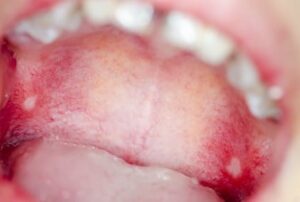 Powikłania leczenia ortodontycznego